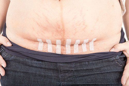 Cách chăm sóc vết mổ sau sinh giúp mẹ nhanh lành, ít sẹo