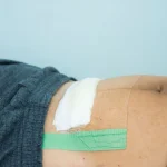vết mổ sau sinh bị đỏ
