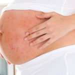 bà bầu bị thủy đậu có ảnh hưởng thai nhi không