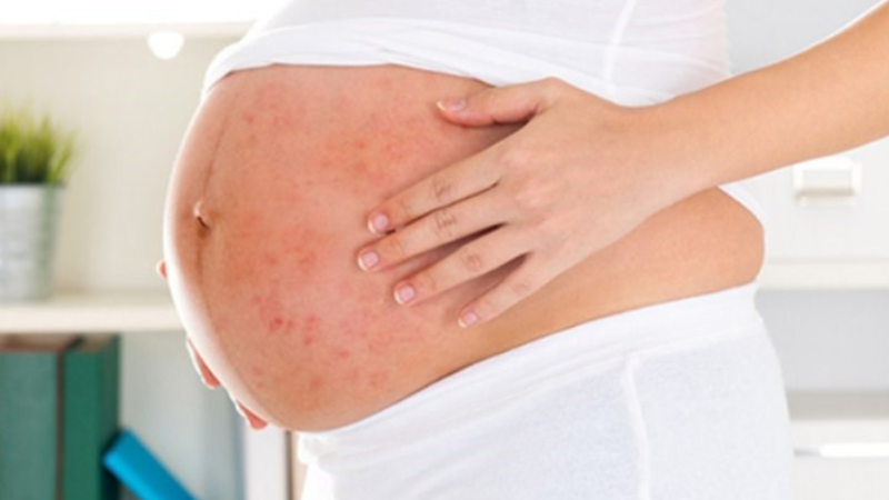 bà bầu bị thủy đậu có ảnh hưởng thai nhi không